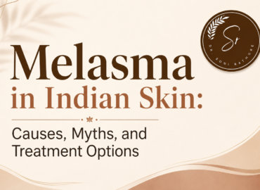 Melasma in Indian Skin
